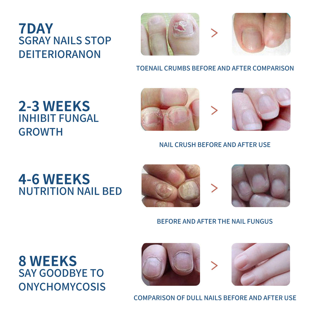 EELHOE Fungal Nail Patches, Toenail Care Soft Nail, Inlay Nail And Thickening Nail Repair Patch