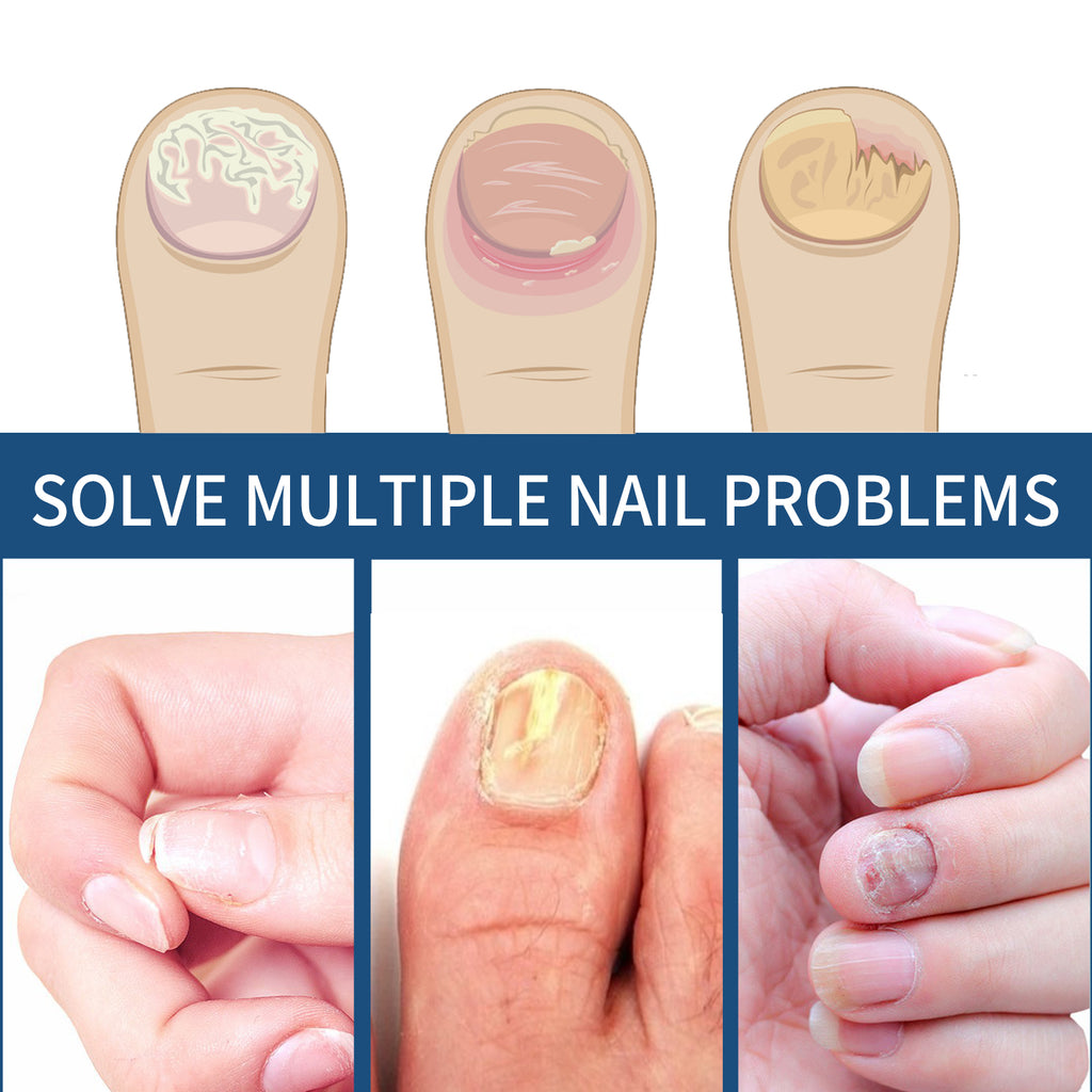 EELHOE Fungal Nail Patches, Toenail Care Soft Nail, Inlay Nail And Thickening Nail Repair Patch